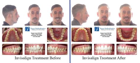 Invisalign Treatment for Adults .